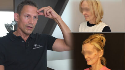 Dr. Mayr Facelift